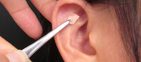 Ear-acupuncture-atlanta-chiropractor